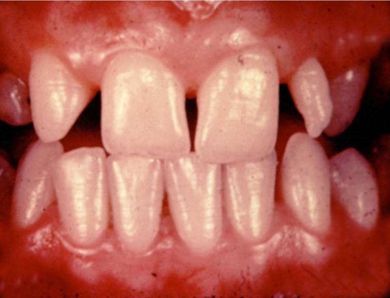 Hypodontia 1.2 Peg 2.jpg